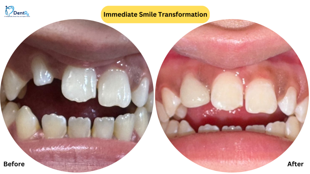Immediate smile transformation